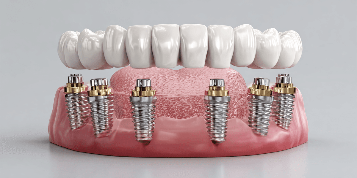 Aesthetic implant bridge replacing missing front teeth