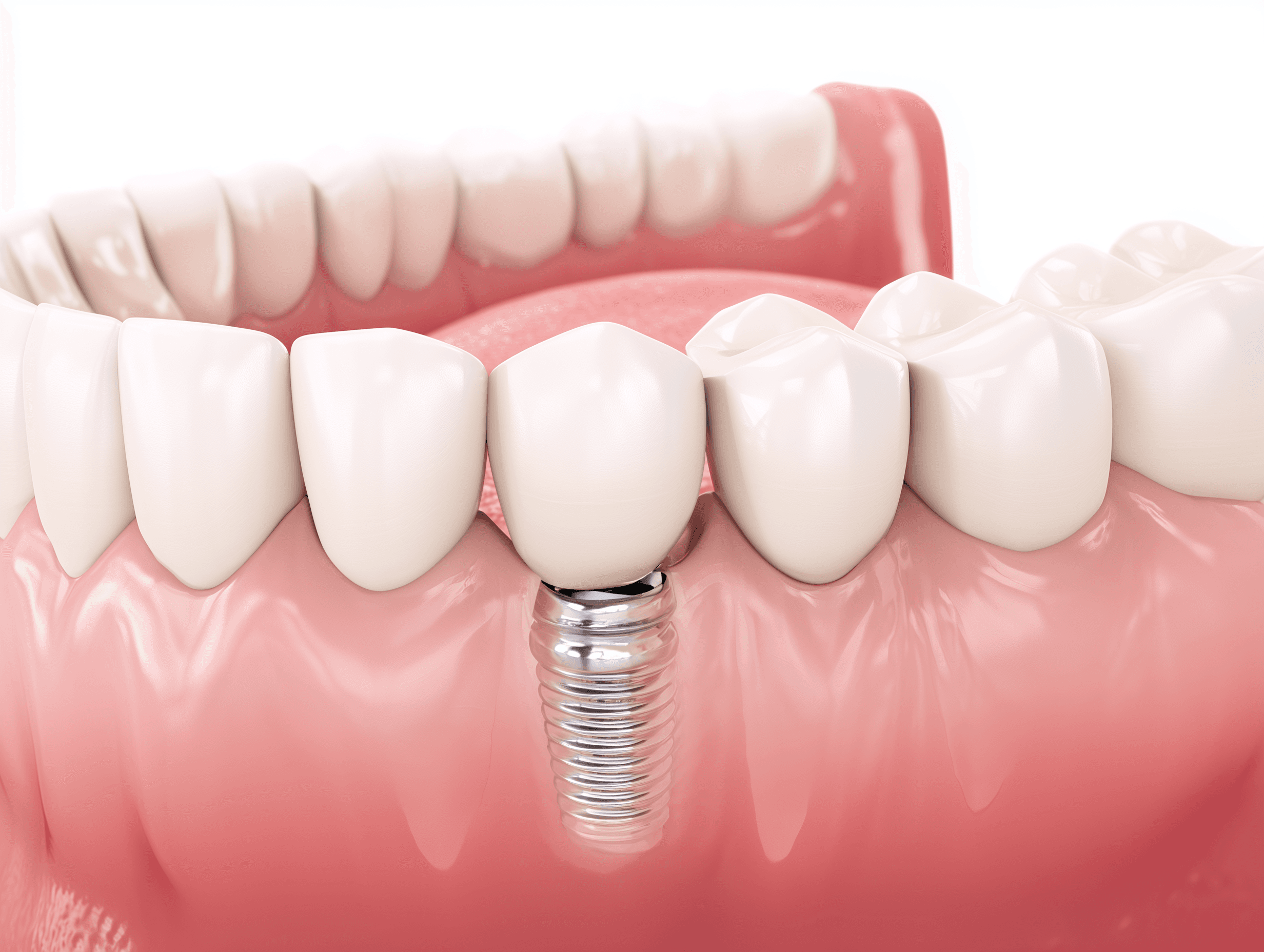 Dental Implants